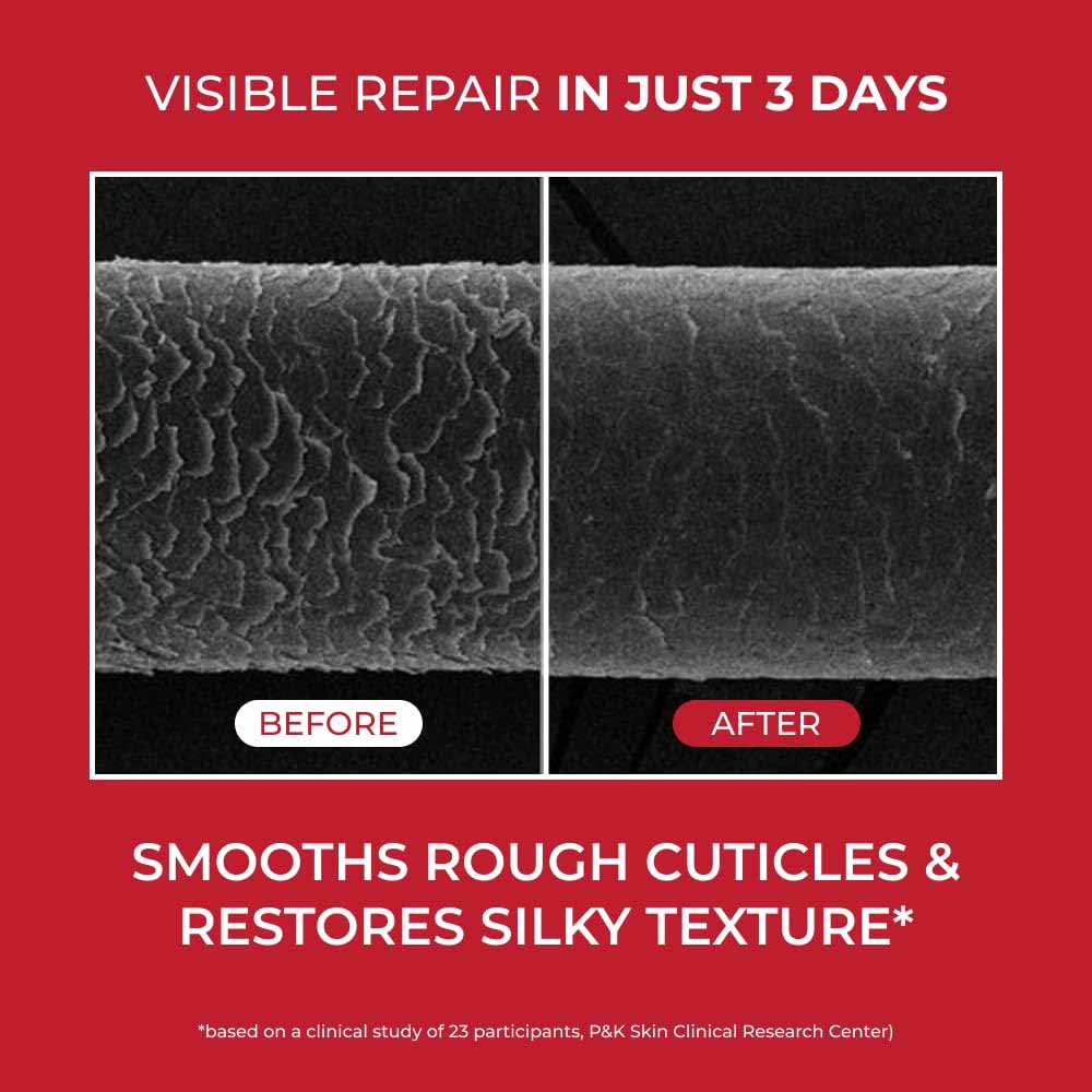 MOEV Annurcatin Treatment