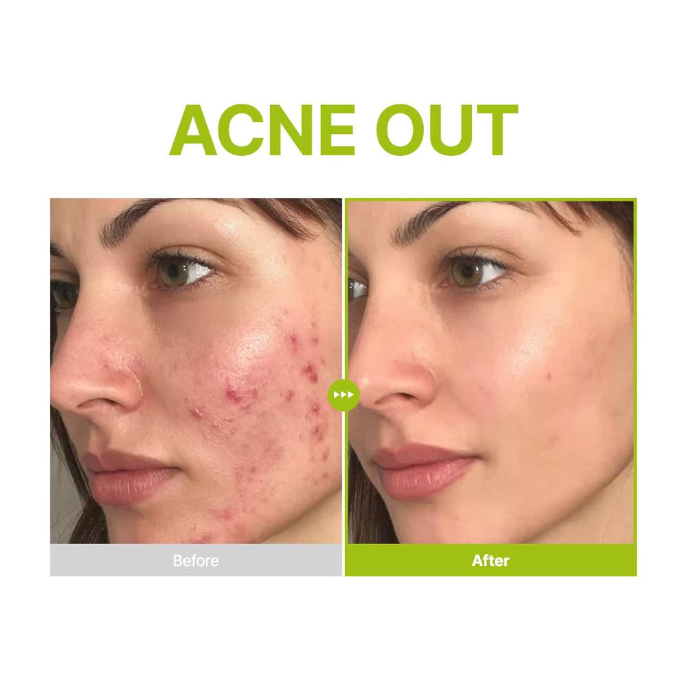 Purito SEOUL - Azelaic Acid 10 Kojic Tea Tree Serum