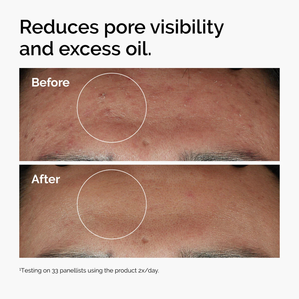 The Ordinary - Niacinamide 10% + Zinc 1% Serum