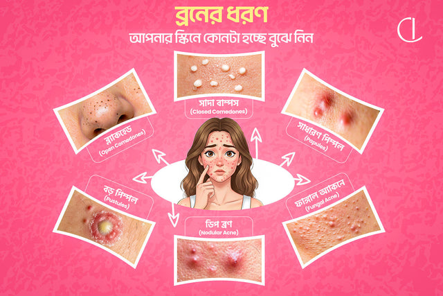 ব্রনের ধরণঃ আপনার স্কিনে কোনটা হচ্ছে বুঝে নিন