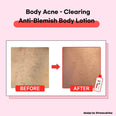 TIAM Anti Blemish Body Lotion Back & Chest