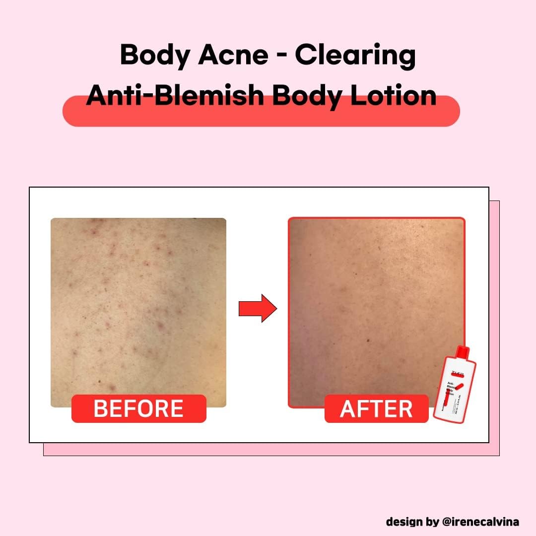 TIAM Anti Blemish Body Lotion Back & Chest