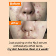 numbuzin No.5 Goodbye Blemish Serum