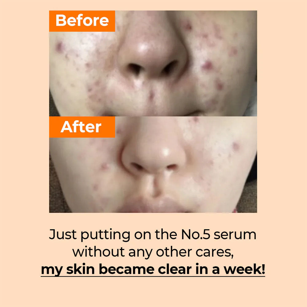 numbuzin No.5 Goodbye Blemish Serum